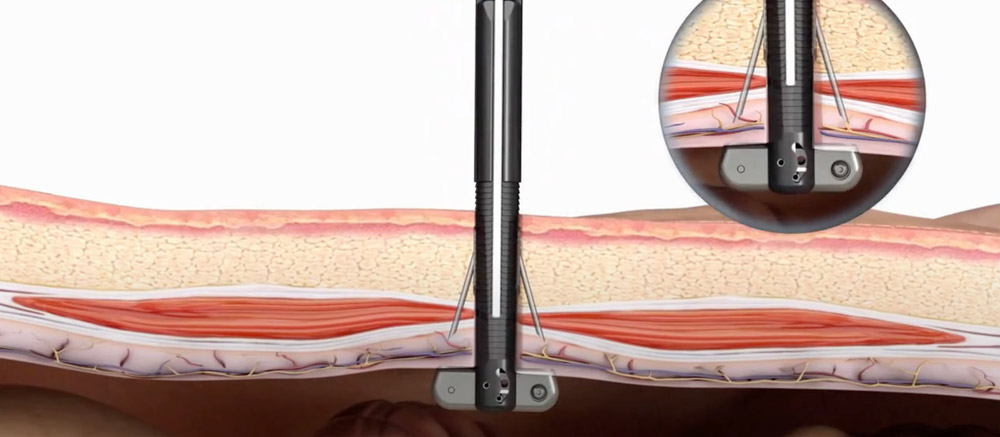 m close kit